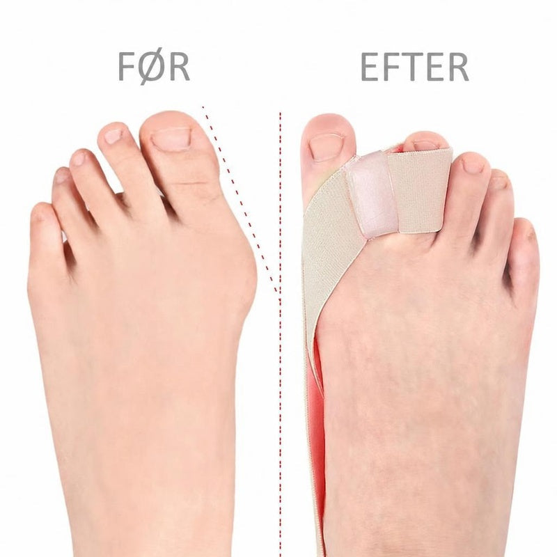 Fod før og efter med beige hallux valgus-band og tåseparator
