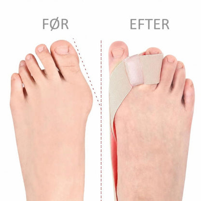Fod før og efter med beige hallux valgus-band og tåseparator