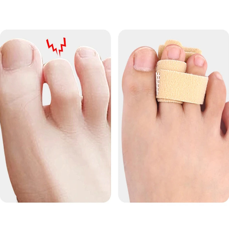 Fodtæer før og efter med beige stabiliserende hammertå-bandage