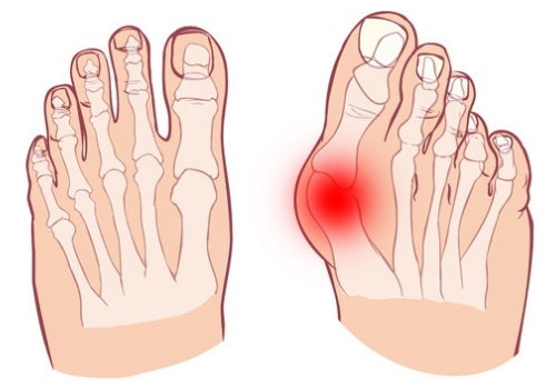 Hallux valgus
