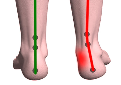 Pronation